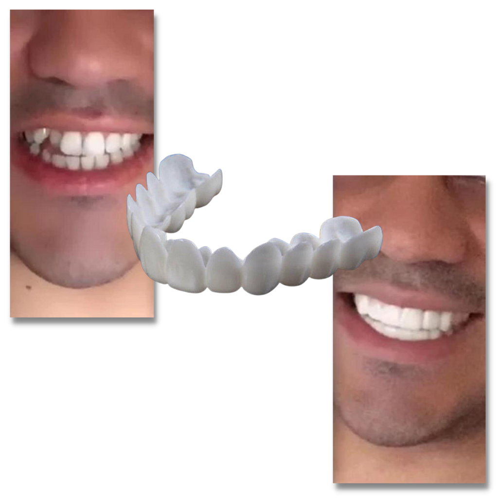 Perfect smile dental coverage - comfortable veneers
